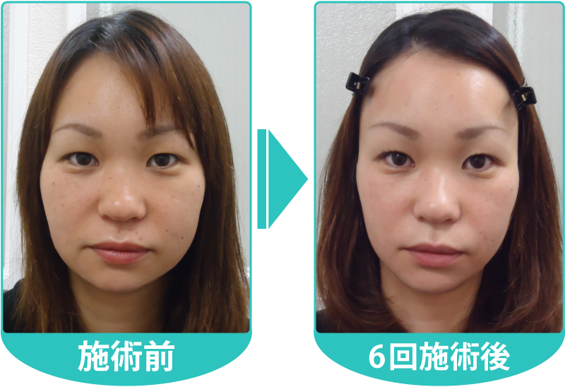 さかな式美顔・小顔矯正