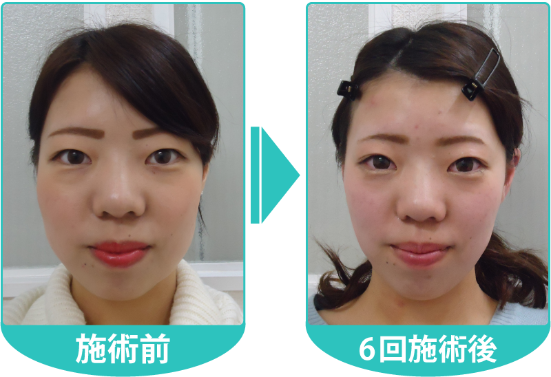 さかな式美顔・小顔矯正