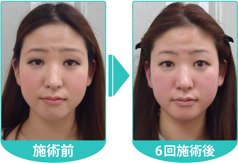 さかな式美顔・小顔矯正